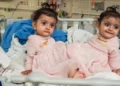 Seattle Children’s Hospital Successfully Separates Conjoined Twin Toddlers in Complex 18-Hour Surgery