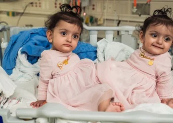 Seattle Children’s Hospital Successfully Separates Conjoined Twin Toddlers in Complex 18-Hour Surgery