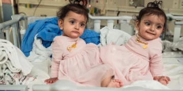 Seattle Children’s Hospital Successfully Separates Conjoined Twin Toddlers in Complex 18-Hour Surgery