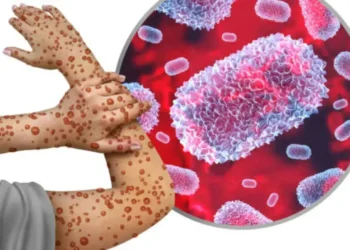 Clade I Mpox Virus Detected in Pierce County Wastewater, No Local Cases Reported