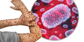 Clade I Mpox Virus Detected in Pierce County Wastewater, No Local Cases Reported