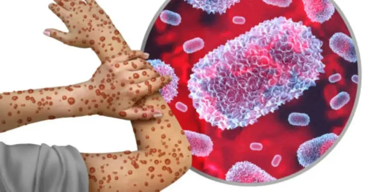 Clade I Mpox Virus Detected in Pierce County Wastewater, No Local Cases Reported